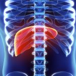 Insuficiencia Hepática Crónica (Cirrosis)